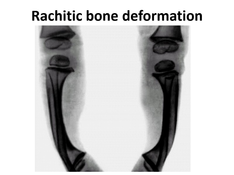 Rachitic bone deformation